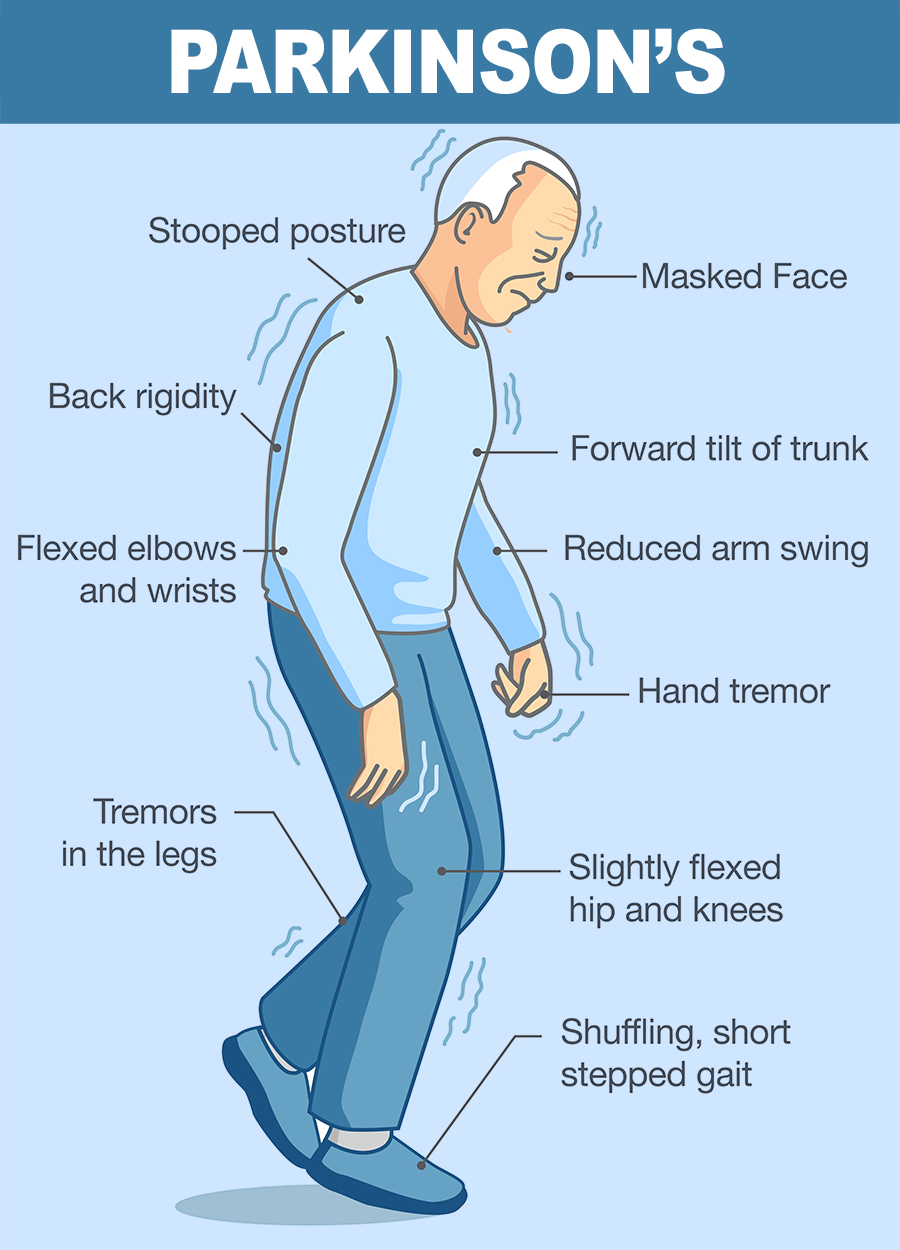 Alzheimer's stance deals